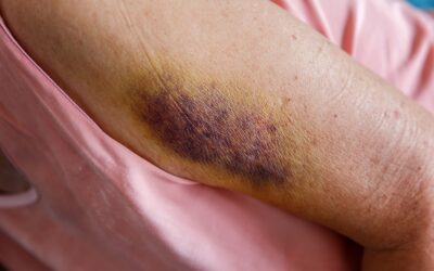 Physical Abuse in Nursing Homes